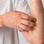 HEALTH TIPS: बारिश में बढ़ जाता है स्किन इंफेक्शन का खतरा,
